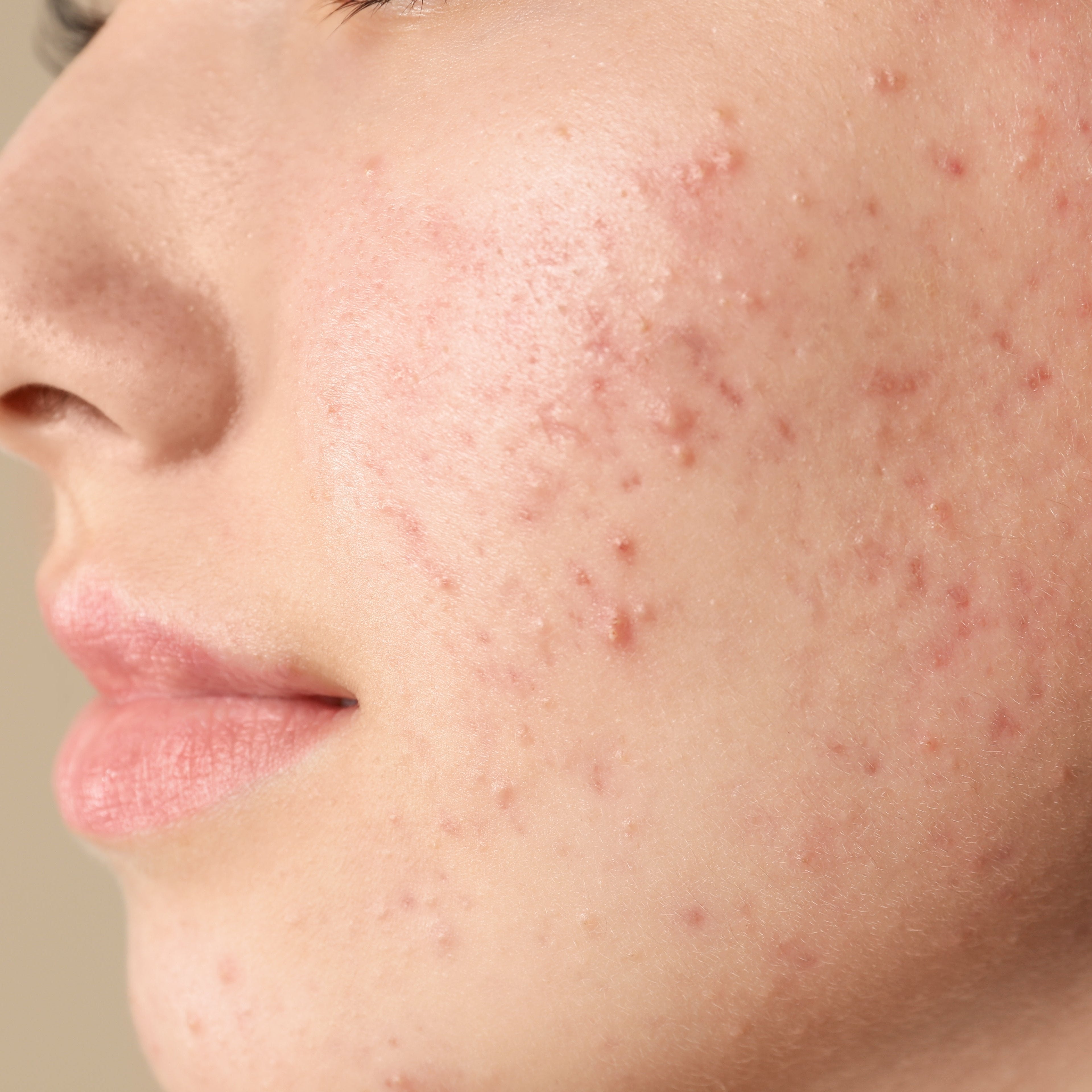 Unreine Haut am Kinn - was hat es damit auf sich?